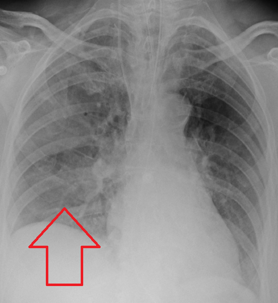 Aspiration pneumonia in a ventilated patient. Speech-Language Pathologists evaluate swallowing disorders (dysphagia) to prevent fluids from accidentally entering the lungs, mitigating severe complications.