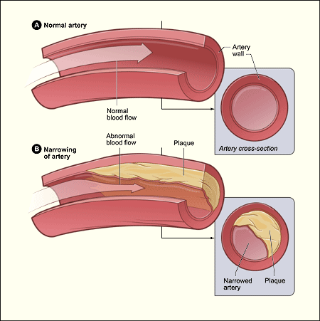 Diagram showing the progression of atherosclerosis, where lipid plaques progressively narrow the arterial lumen and increase blood pressure.