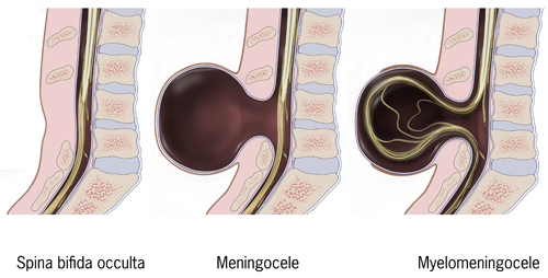Spina bifida occurs in varying degrees of severity, depending on how and where the neural tube fails to close around the spinal cord during prenatal development.
