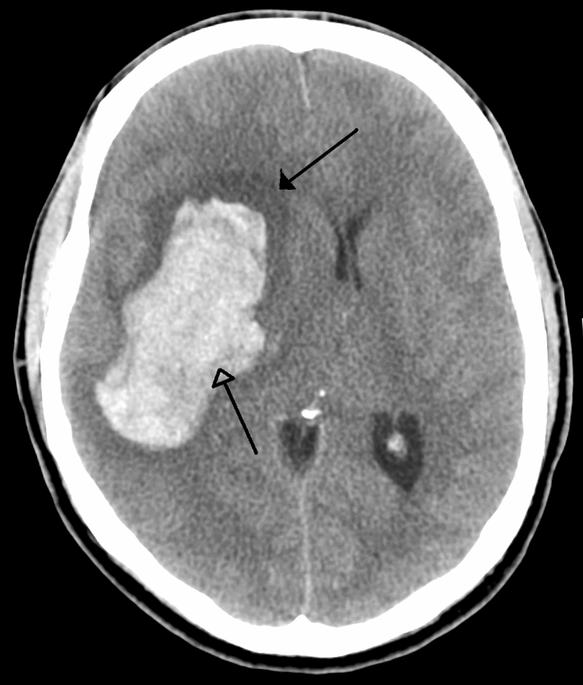 CT scan showing an intraparenchymal hemorrhage and surrounding cerebral edema, a condition that critically increases intracranial pressure.