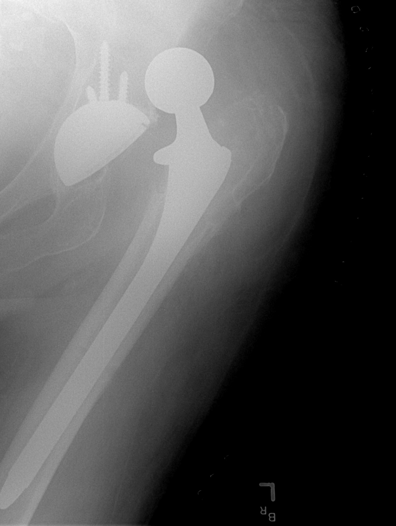 Following a total hip arthroplasty, the patient's legs must remain abducted (using an abduction pillow) to prevent a catastrophic joint dislocation.