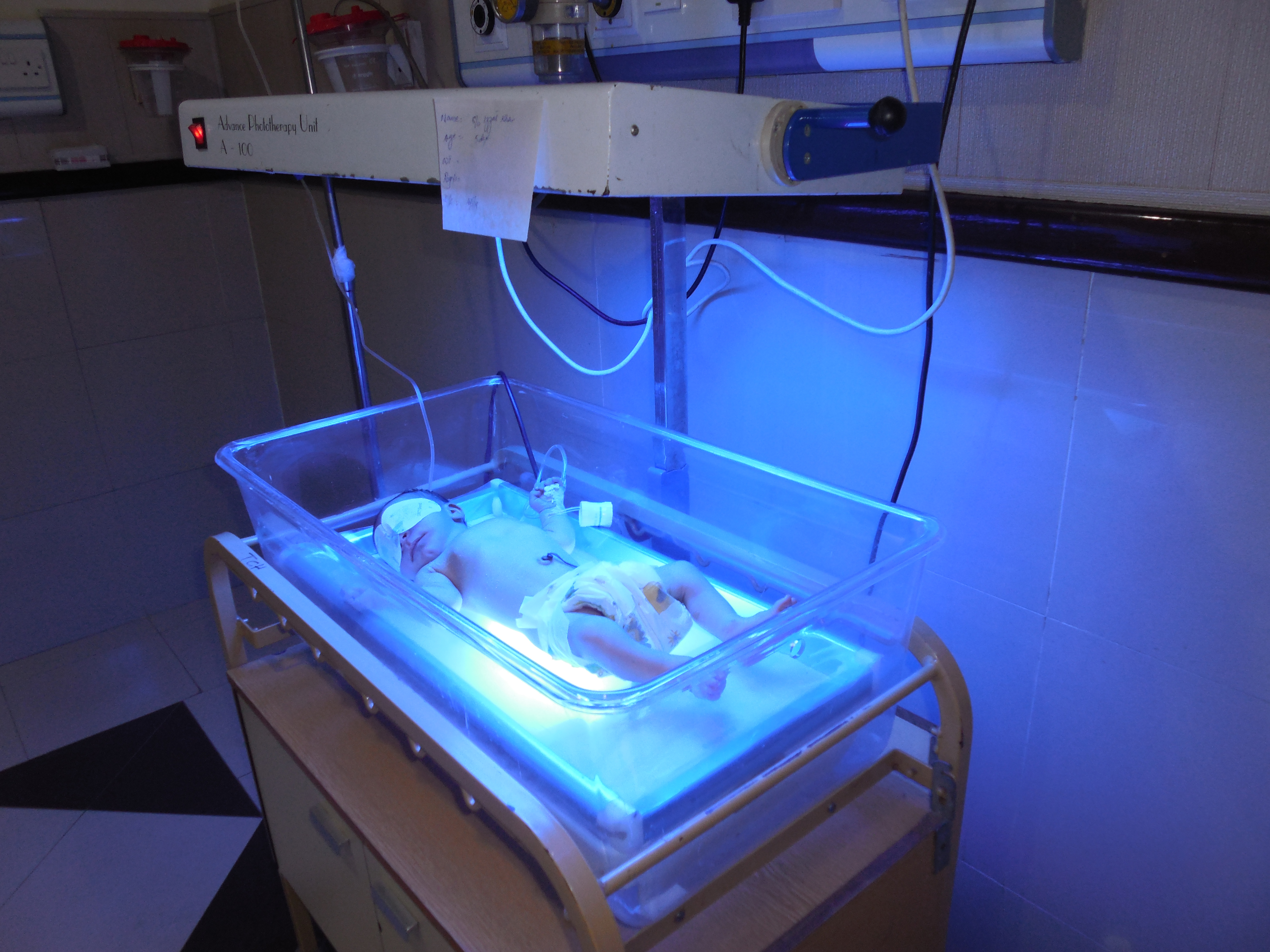 A neonate undergoing phototherapy to treat hyperbilirubinemia. Note the use of opaque eye patches to prevent retinal damage.