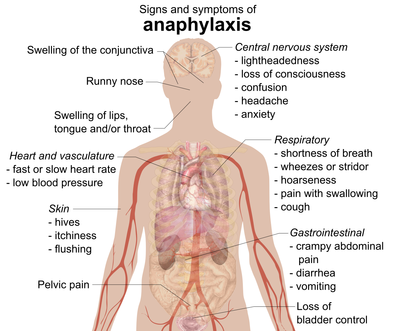 Systemic manifestations of anaphylaxis. The massive release of histamine triggers life-threatening respiratory tract edema and sudden cardiovascular collapse.