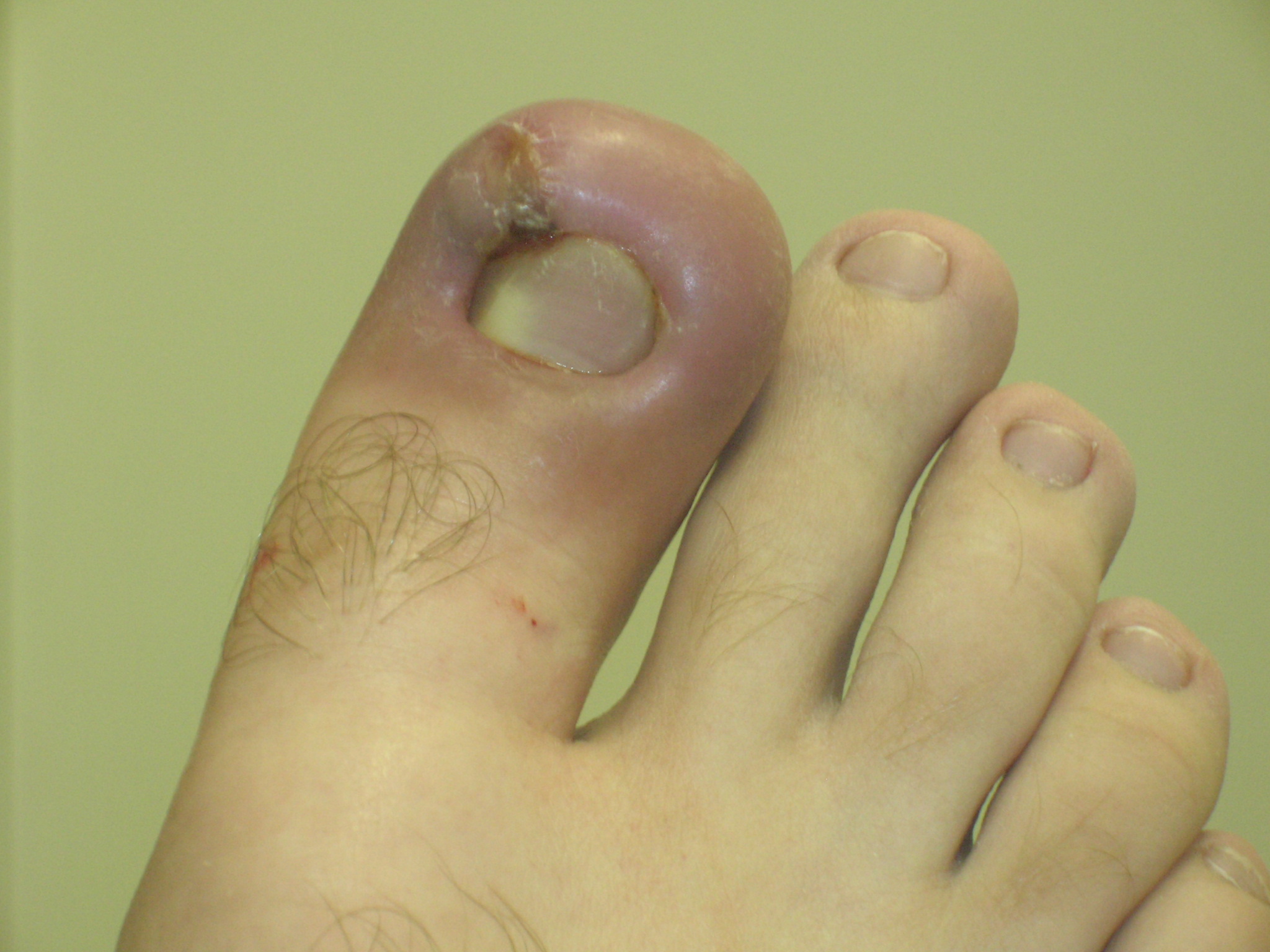 A localized infection demonstrating the classic signs of inflammation: redness, visible swelling, and cellular impairment.