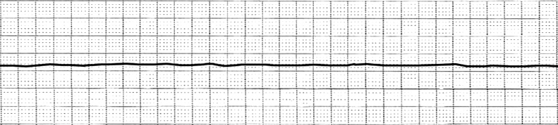 An electrocardiogram showing asystole, or a "flatline." In grammar, a sentence lacking a functioning verb is entirely lifeless and cannot deliver a complete thought.