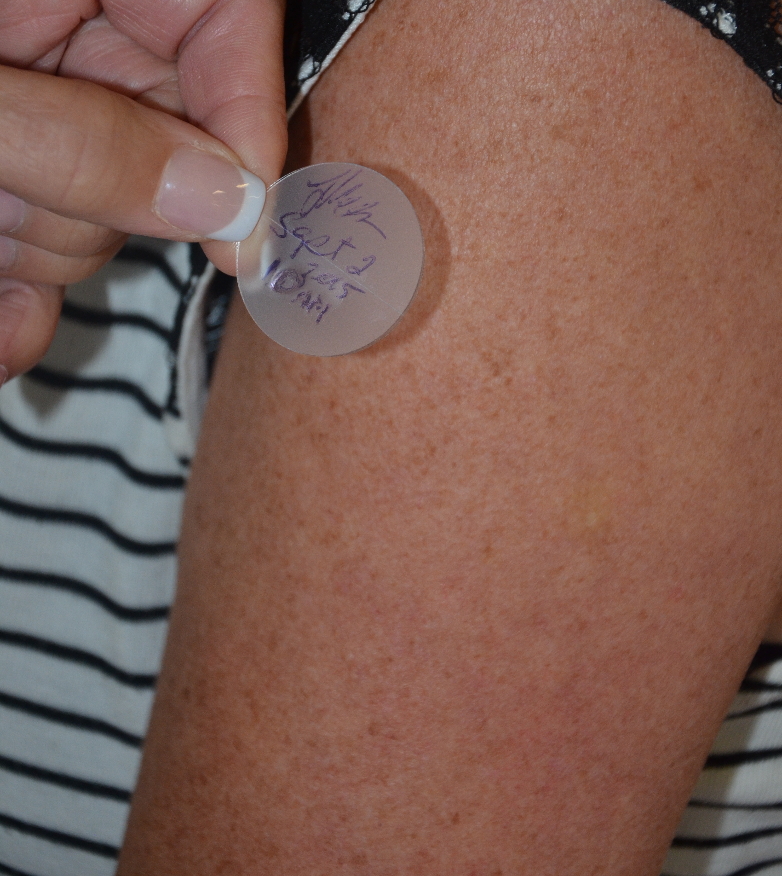 A transdermal medication patch applied to clean, hairless skin. Note that the patch is properly labeled with the administration time, date, and the administering nurse's initials.