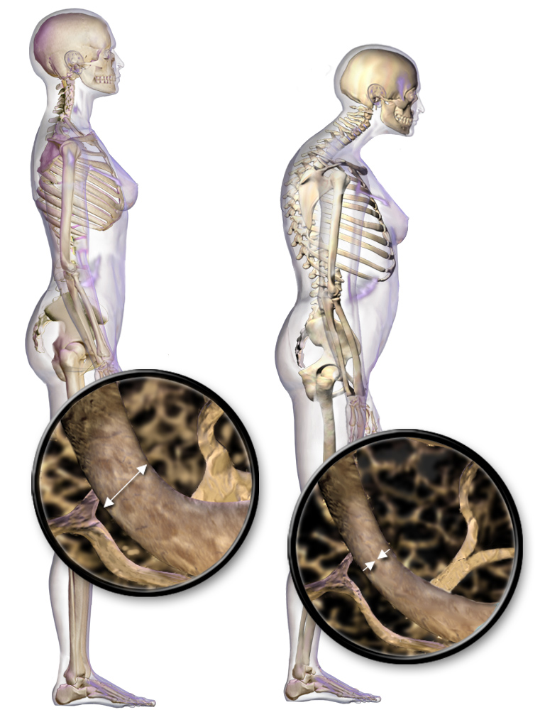 The decline in estrogen during menopause accelerates bone resorption, leading to compromised bone density and postural changes associated with osteoporosis.