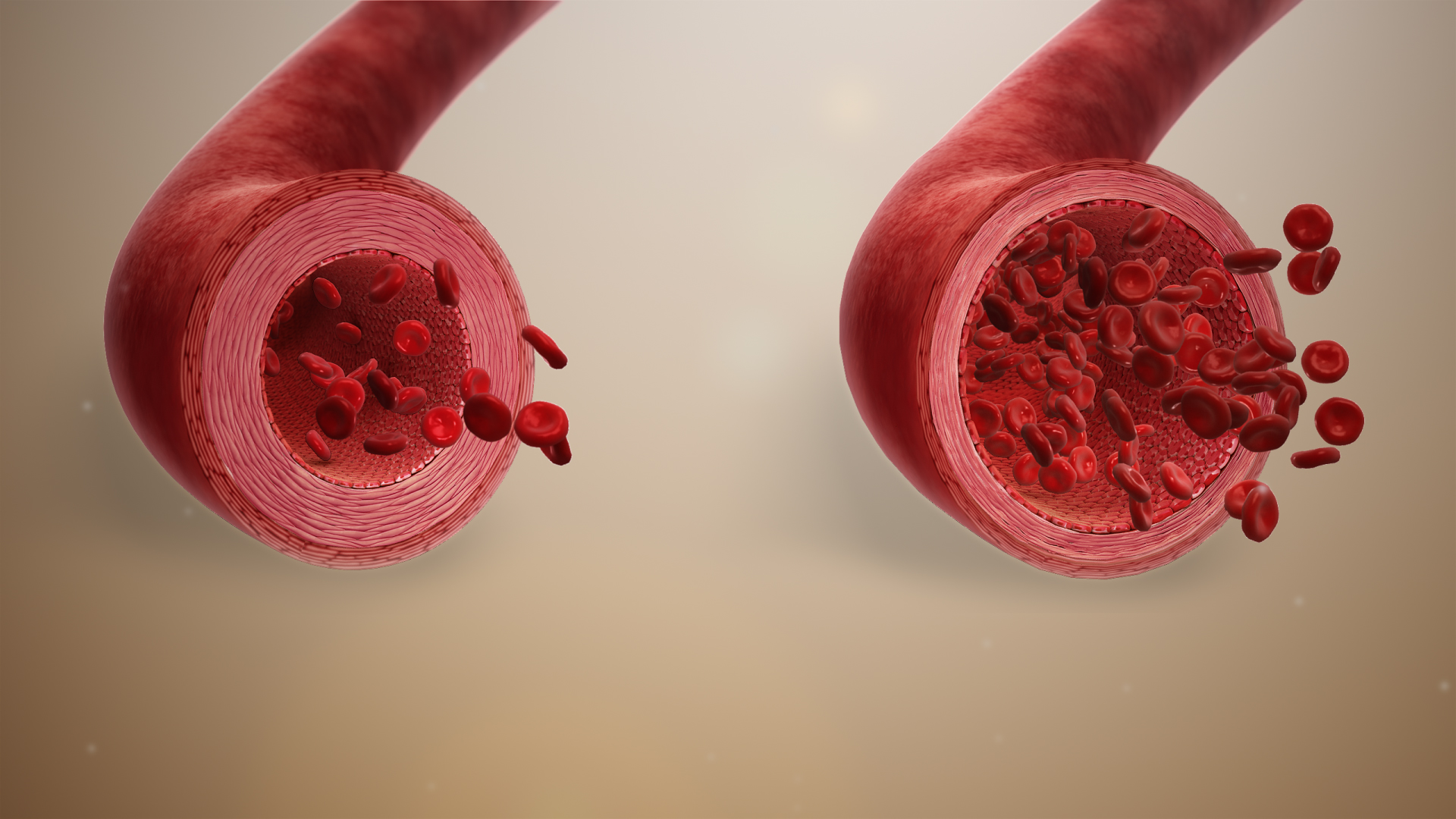Comparison of a normal blood vessel to one undergoing profound vasodilation, a primary mechanism reducing systemic vascular resistance in distributive shock.
