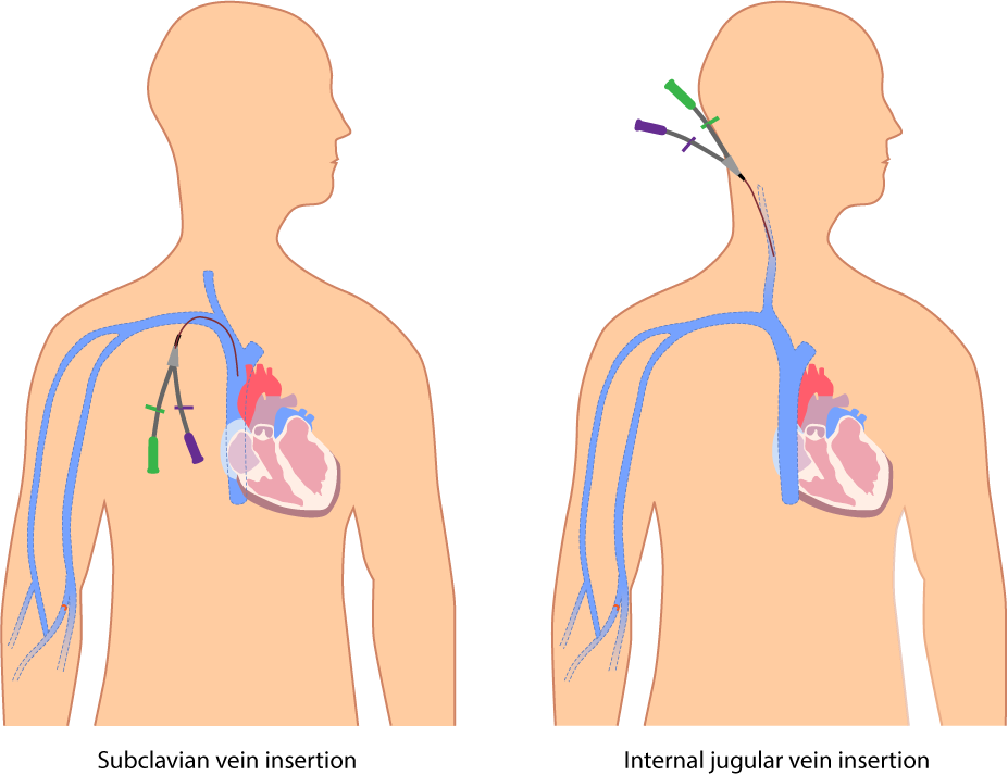 Central venous catheters provide direct access to the large veins near the heart, where intrathoracic pressure becomes negative during inhalation.
