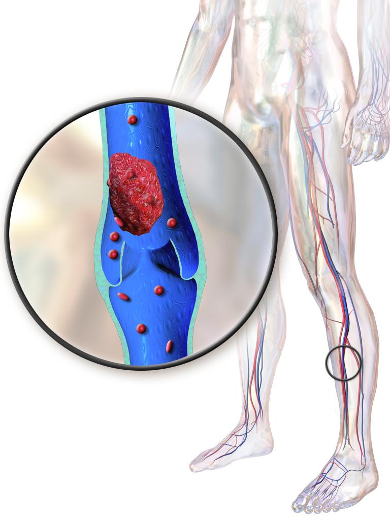 Illustration of a deep vein thrombosis (DVT) obstructing venous blood flow, a significant risk stemming from the physiological hypercoagulable state of pregnancy.