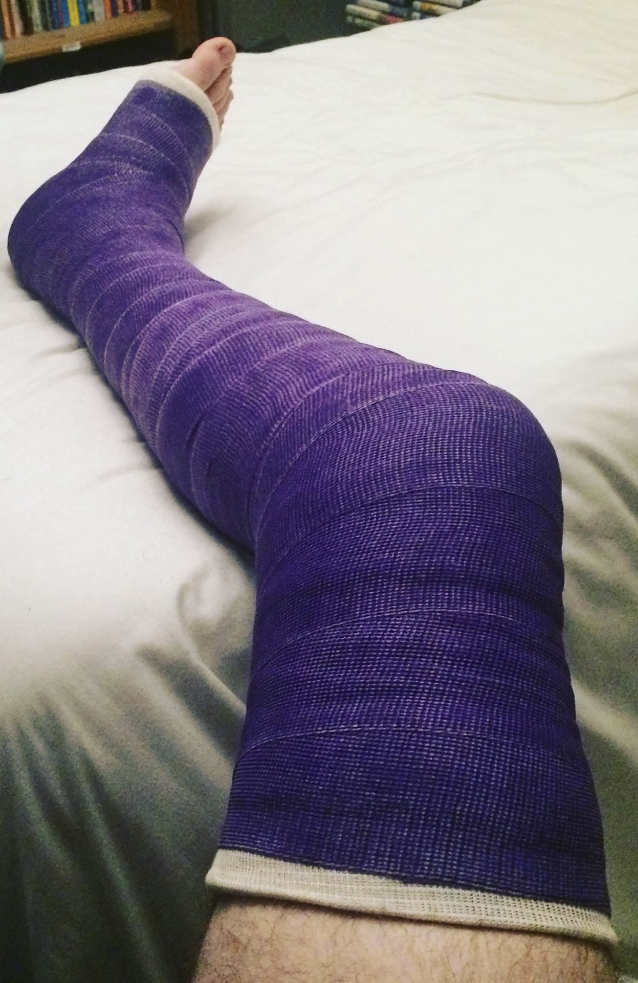 An orthopedic cast applied to immobilize a patient's leg, ensuring correct anatomical alignment and restricting kinetic movement during the healing process.