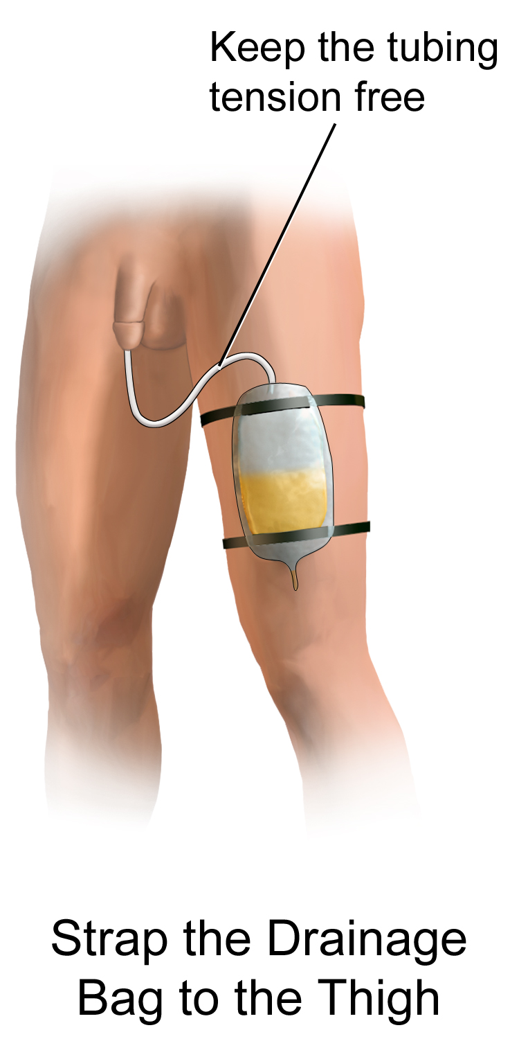 An indwelling Foley catheter and drainage bag. The collection bag must be positioned below the bladder at all times to utilize gravity and prevent infectious backflow.