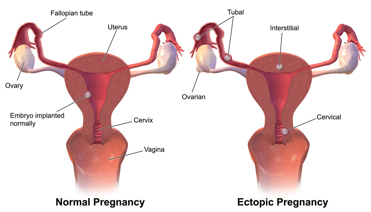 Diagram illustrating an ectopic pregnancy, where the embryo implants dangerously outside the endometrial cavity, typically within the fallopian tube.