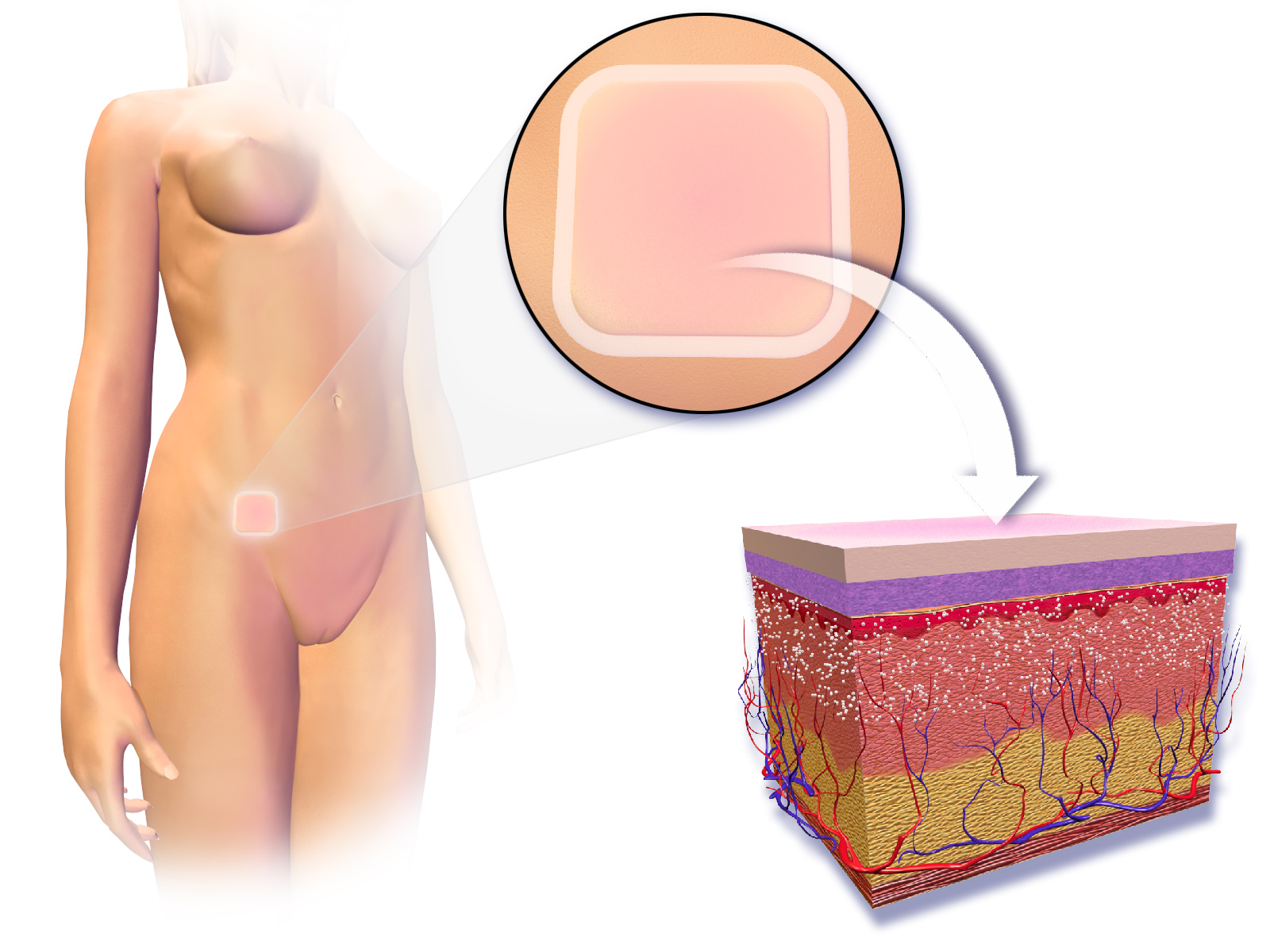 Transdermal contraceptive patches deliver hormones directly through the skin and subcutaneous fat. Increased adipose tissue in patients weighing over 198 pounds can impede adequate systemic drug distribution, reducing contraceptive efficacy.