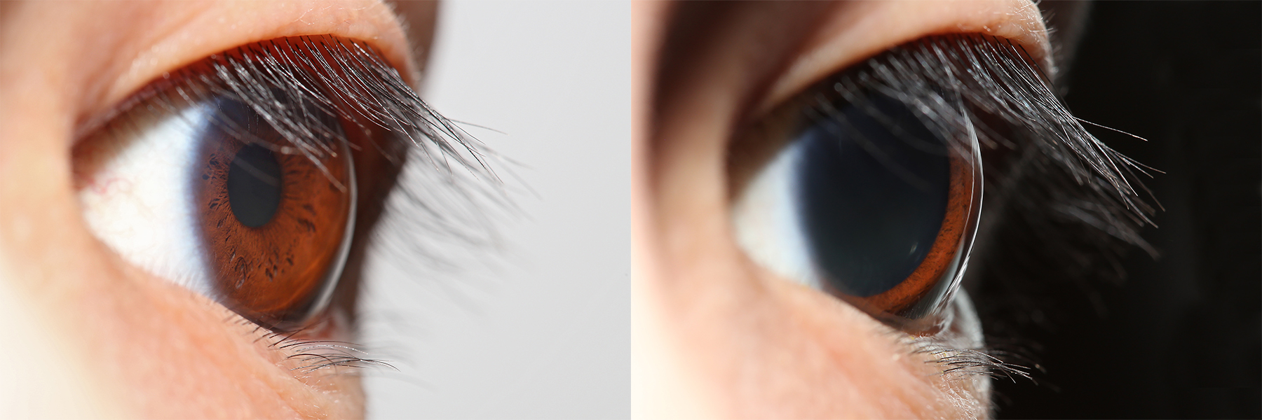 The pupillary light reflex: Pupils properly constrict in response to bright light (left) and dilate in dim environments (right), testing the neurological integrity of Cranial Nerve III.