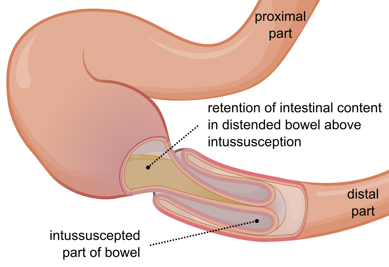 Diagram illustrating intussusception, where one segment of the bowel mechanically telescopes into an adjacent section. The resulting ischemia causes bleeding that mixes with mucus, yielding the classic "currant jelly" stools.