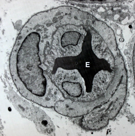 Electron micrograph displaying an erythrocyte deformed within a microvessel lumen due to vasoconstriction, demonstrating how cold therapy physically restricts local blood flow.