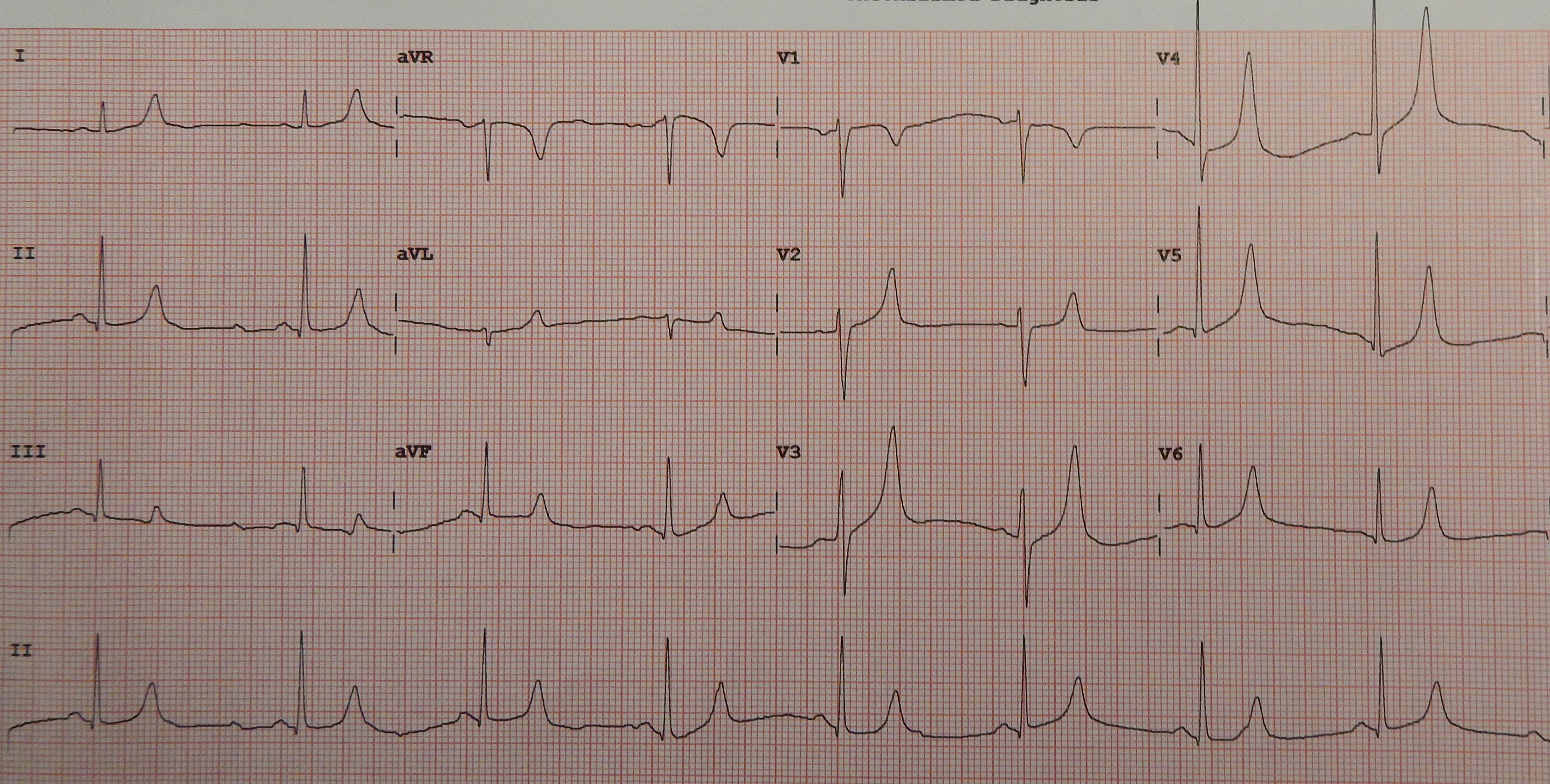 ECG tracing demonstrating tall, peaked T waves, the hallmark electrophysiological indicator of severe hyperkalemia.