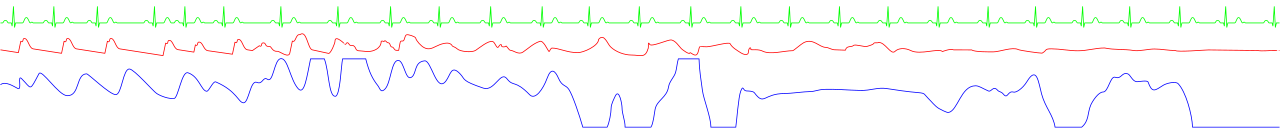 Monitoring strip showing Pulseless Electrical Activity (PEA), where organized electrical signals (green) continue despite a complete failure of mechanical pumping and blood pressure (red).