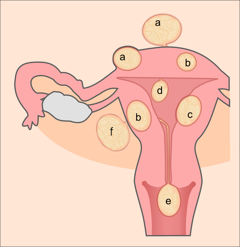 Schematic depicting the various anatomical locations where benign uterine fibroids (leiomyomas) can develop, such as submucosal, intramural, and subserosal regions.