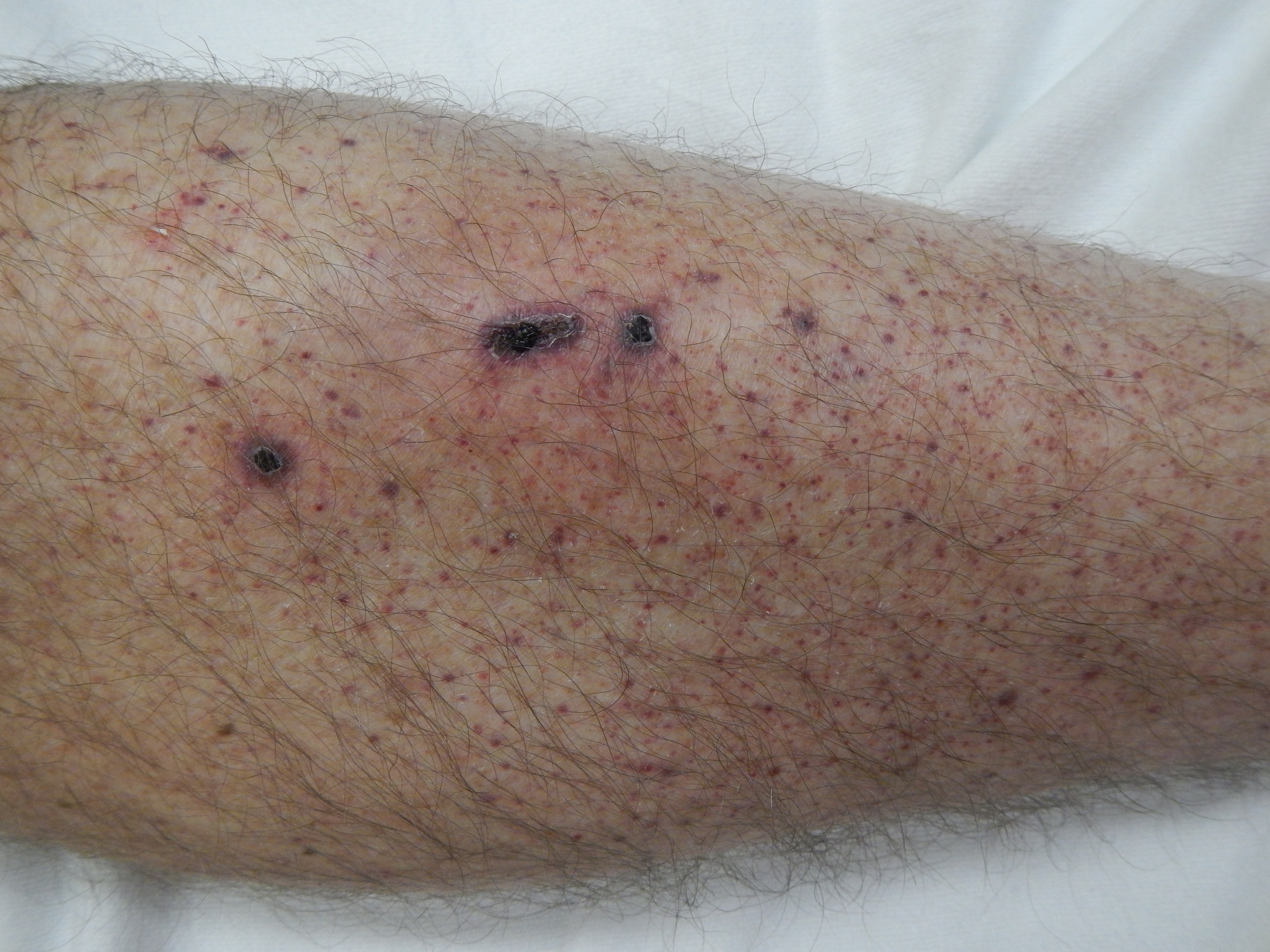 Petechiae on the lower leg resulting from severe thrombocytopenia. Without sufficient platelets, spontaneous capillary bleeding occurs.