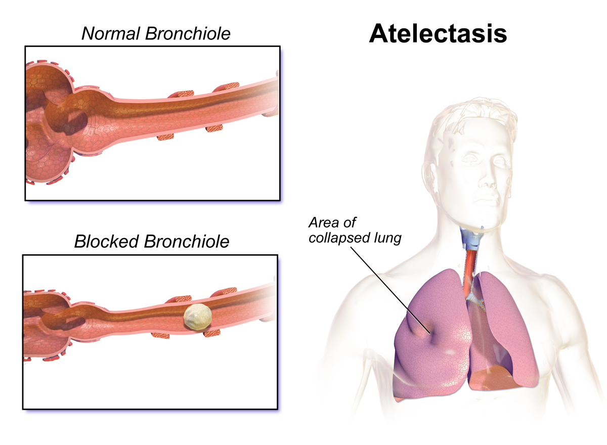 Atelectasis occurs when shallow postoperative breathing causes the alveolar sacs at the lung bases to collapse, severely reducing gas exchange.