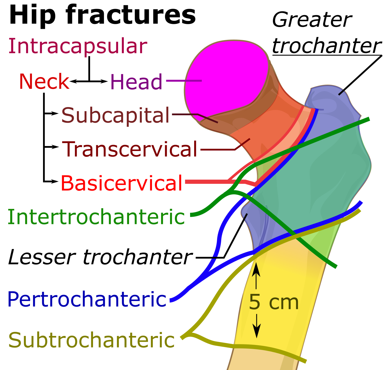 Anatomical classification of hip fractures. Environmental hazards combined with gait instability frequently result in these traumatic kinetic events, severely compromising patient independence.