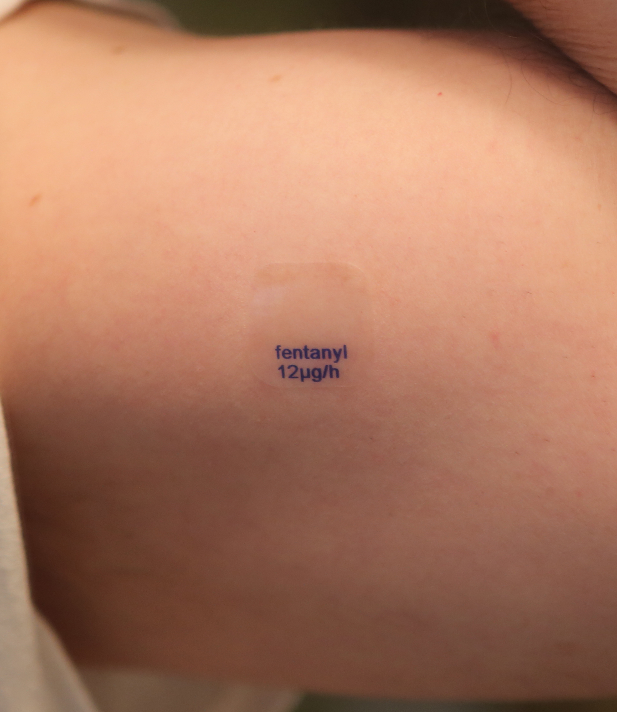 Transdermal fentanyl patches provide continuous opioid delivery over 72 hours but are strictly reserved for opioid-tolerant clients experiencing chronic, severe pain.