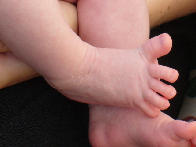 A normal Babinski reflex in a healthy newborn, demonstrating the characteristic fanning and extension of the toes due to incomplete myelination of the corticospinal tracts.