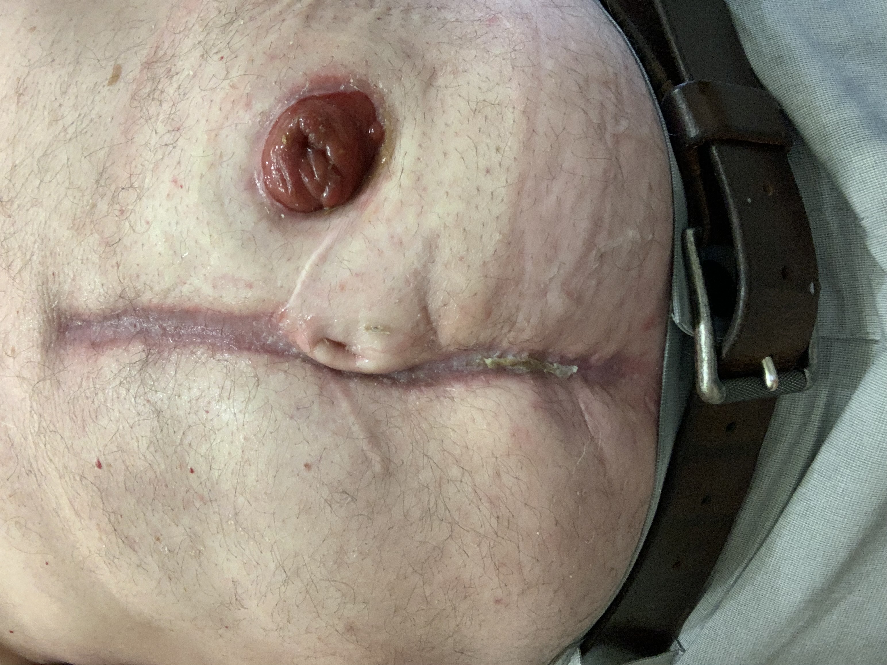 A healthy ostomy stoma is highly vascular, appearing beefy red and moist.
