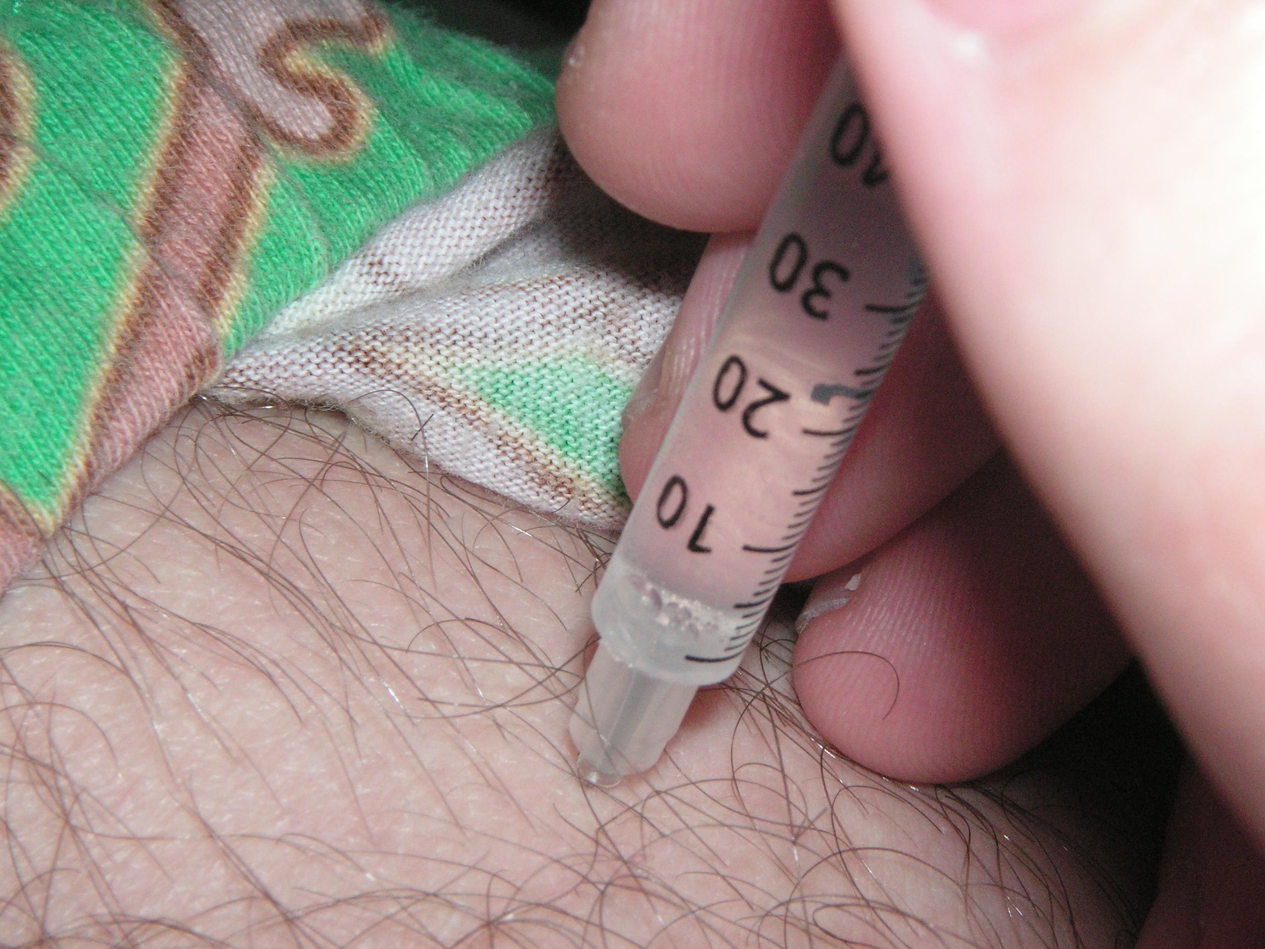 The LPN's scope of practice includes administering intramuscular and oral medications to clinically stable clients.