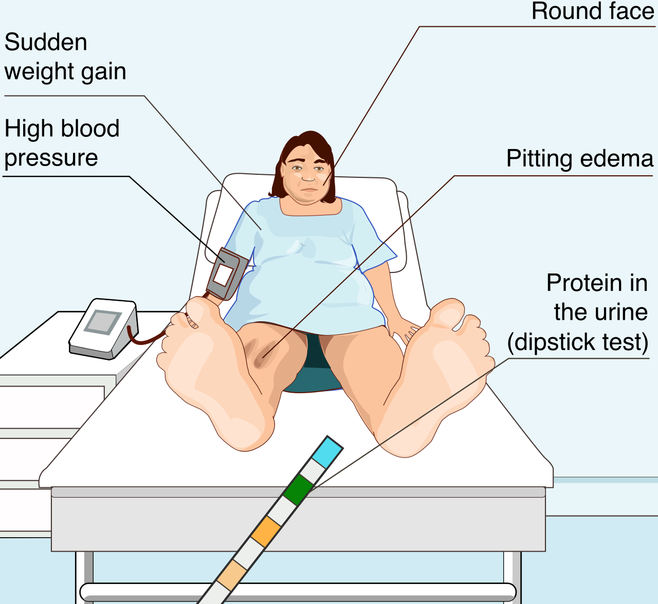 Overview of the systemic symptoms and organ damage caused by endothelial dysfunction and vasospasm in preeclampsia.