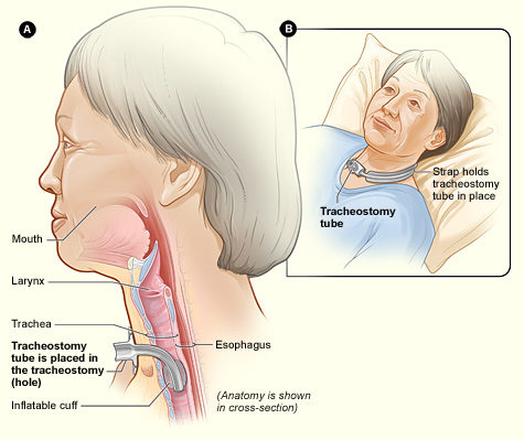 Medical diagram demonstrating the placement of a tracheostomy tube. Performing invasive, advanced procedures outside your authorized nursing scope during a public emergency constitutes gross negligence and instantly voids Good Samaritan legal protections.