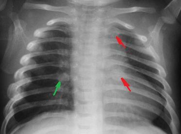 Radiograph revealing infant rib fractures, a strong clinical indicator of child abuse. In Dubai, mere suspicion of such non-accidental injuries triggers a mandatory legal duty for nurses to report to authorities.
