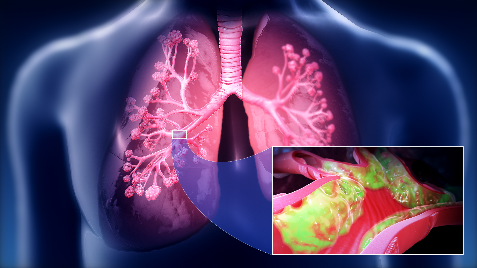The accumulation of mucus and respiratory secretions in the airway produces the noisy breathing commonly known as the "death rattle".