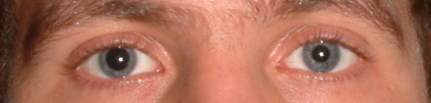 Asymmetrical pupils (anisocoria) can be a critical sign of rising intracranial pressure and oculomotor nerve compression.