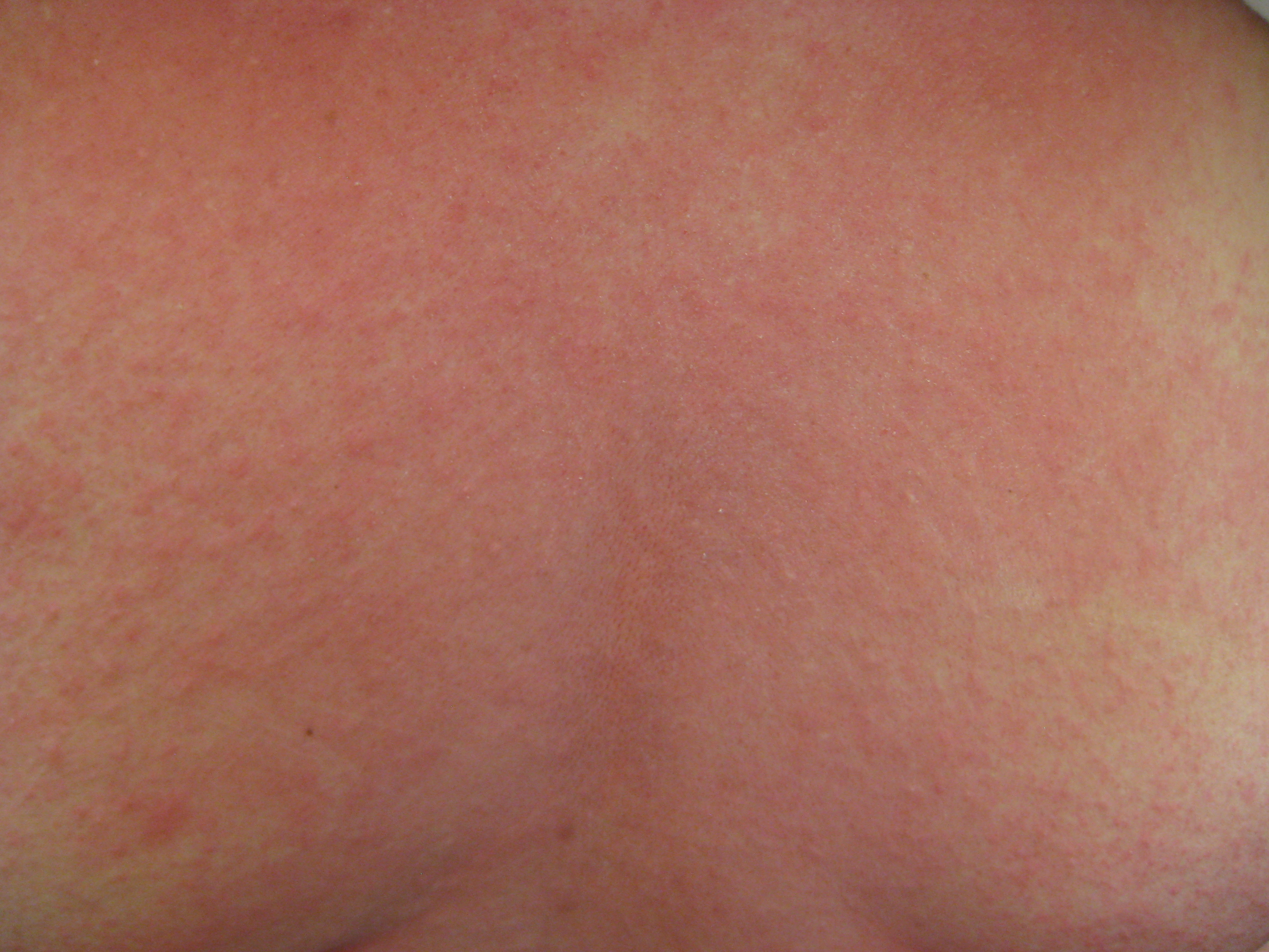 Urticaria (hives) and flushing on the chest are common physical signs of anaphylaxis, requiring the immediate cessation of any intravenous antigen exposure.