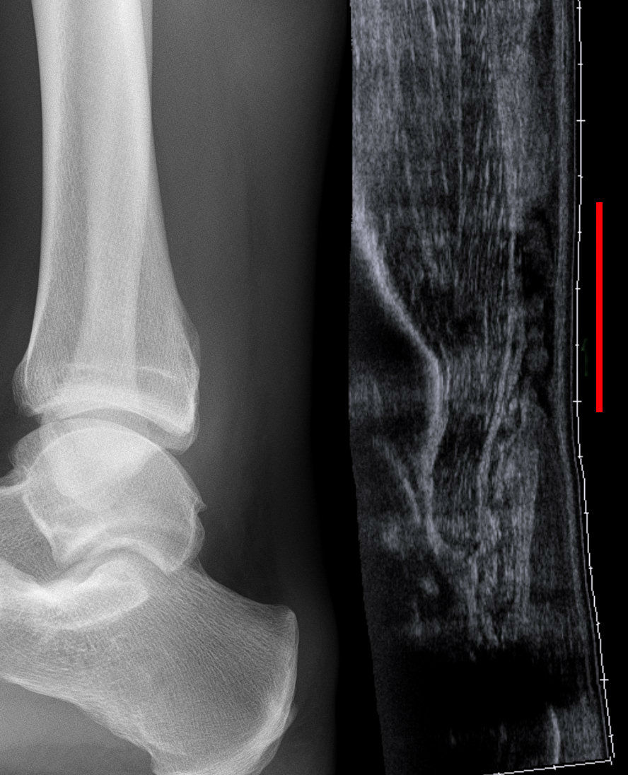 An ultrasound image revealing a discontinuity in the Achilles tendon (indicated by the red line). Fluoroquinolone antibiotics carry a black box warning for causing this specific tendon rupture.