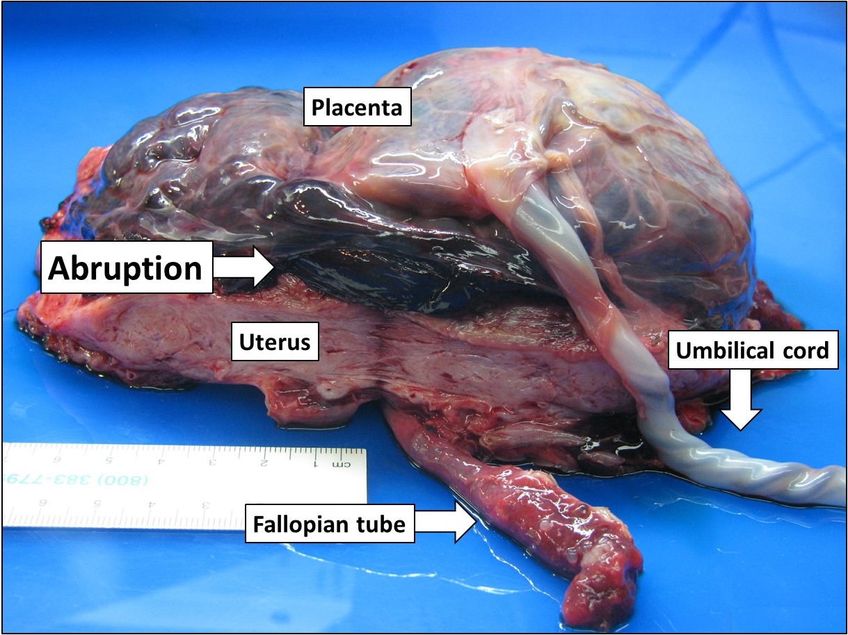 Gross pathology of a placental abruption, revealing the large hematoma that forms as the placenta prematurely detaches from the uterine wall, a life-threatening obstetric emergency.