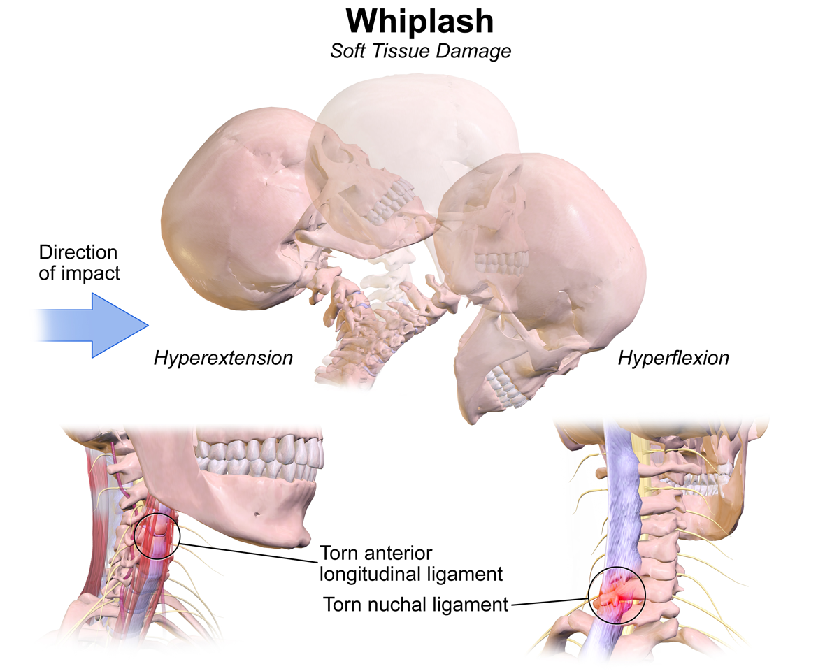 Whiplash illustrates a residual risk: the remaining potential for injury that persists even after the primary mitigation strategy (wearing a seatbelt) has been successfully deployed.