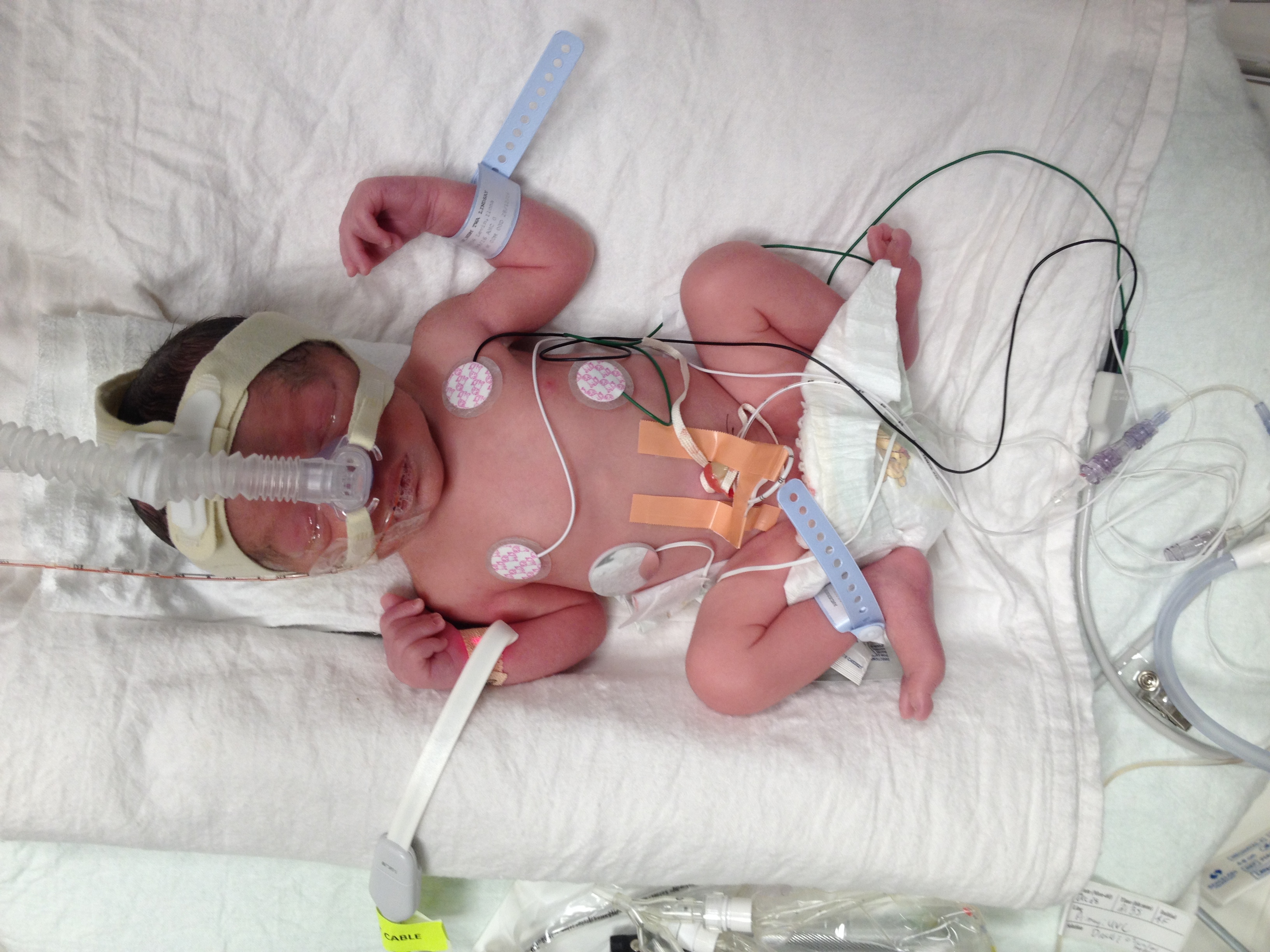 Premature infants require high levels of caregiving, which can increase caregiver strain and represents a known risk factor for child abuse.