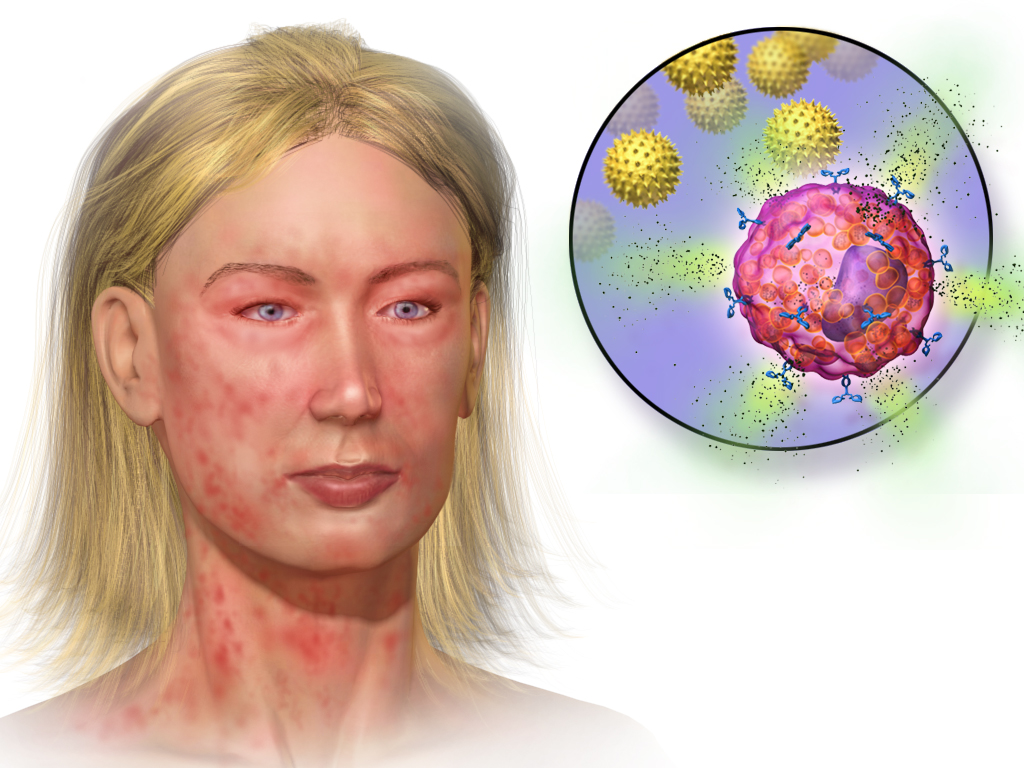 During anaphylaxis, exposure to an allergen triggers mast cells to degranulate, releasing massive amounts of inflammatory mediators like histamine. This results in systemic vasodilation, dangerous hypotension, and severe bronchoconstriction.