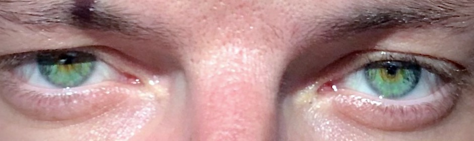 Miosis (pinpoint pupils) combined with an altered level of consciousness and respiratory depression are hallmark signs of severe opioid intoxication.
