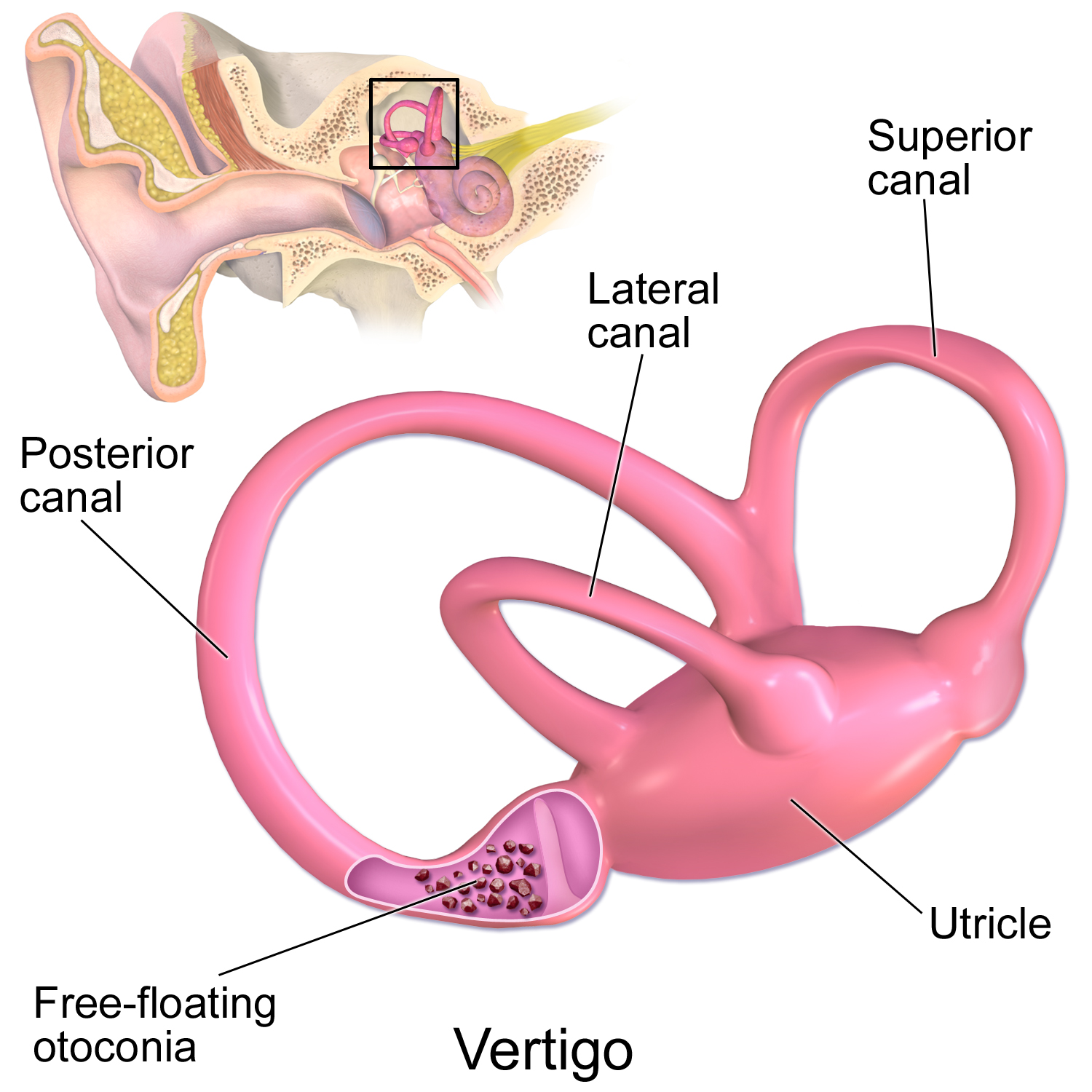 The vestibular system of the inner ear. Because these semicircular canals are highly sensitive to temperature changes, cold ear drops can cause severe dizziness and vertigo.