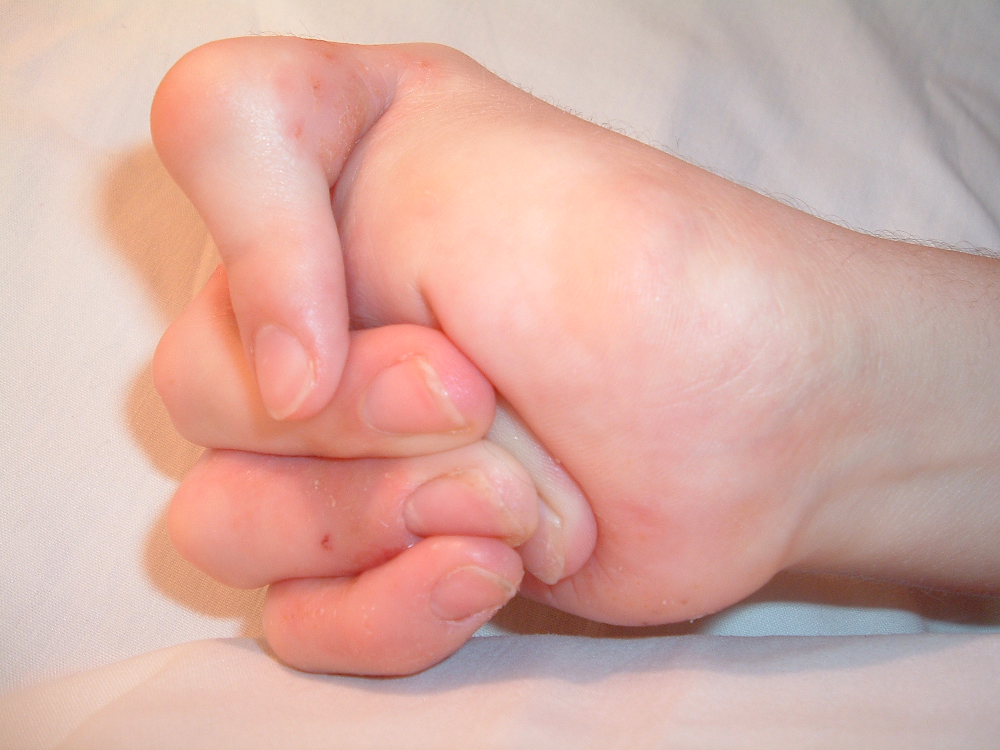 Without frequent range of motion exercises, unused joints can develop permanent contractures, effectively freezing the joint in an abnormal, contracted position.