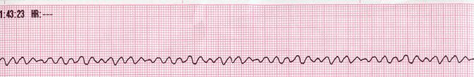 Ventricular fibrillation on an electrocardiogram presents as a chaotic, disorganized baseline with no identifiable QRS complexes, resulting in zero cardiac output.
