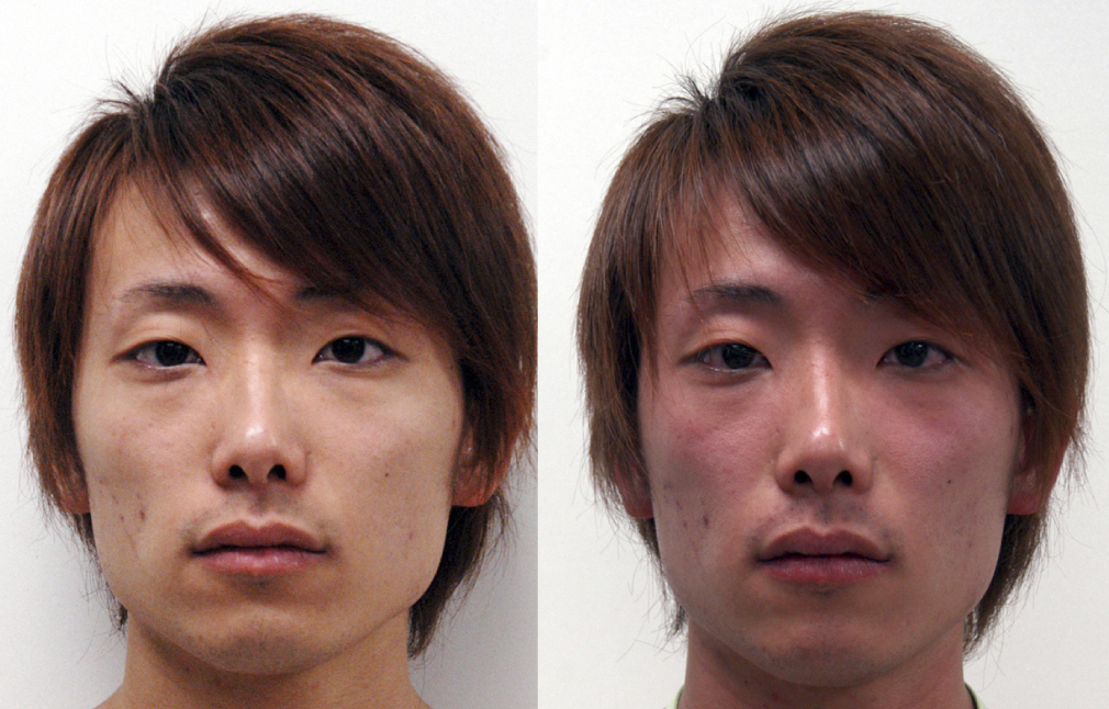 Facial flushing is a hallmark clinical sign of a disulfiram-like reaction, which occurs when alcohol is consumed alongside medications like metronidazole.