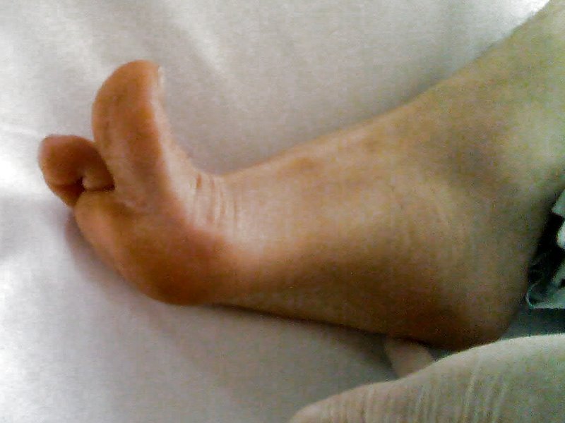 A positive (pathological) Babinski reflex in an adult, indicated by the fanning of the toes, signifies upper motor neuron damage.