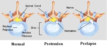 Spinal twisting under a heavy load exerts dangerous shearing forces on intervertebral discs, progressively leading to bulging or herniation.