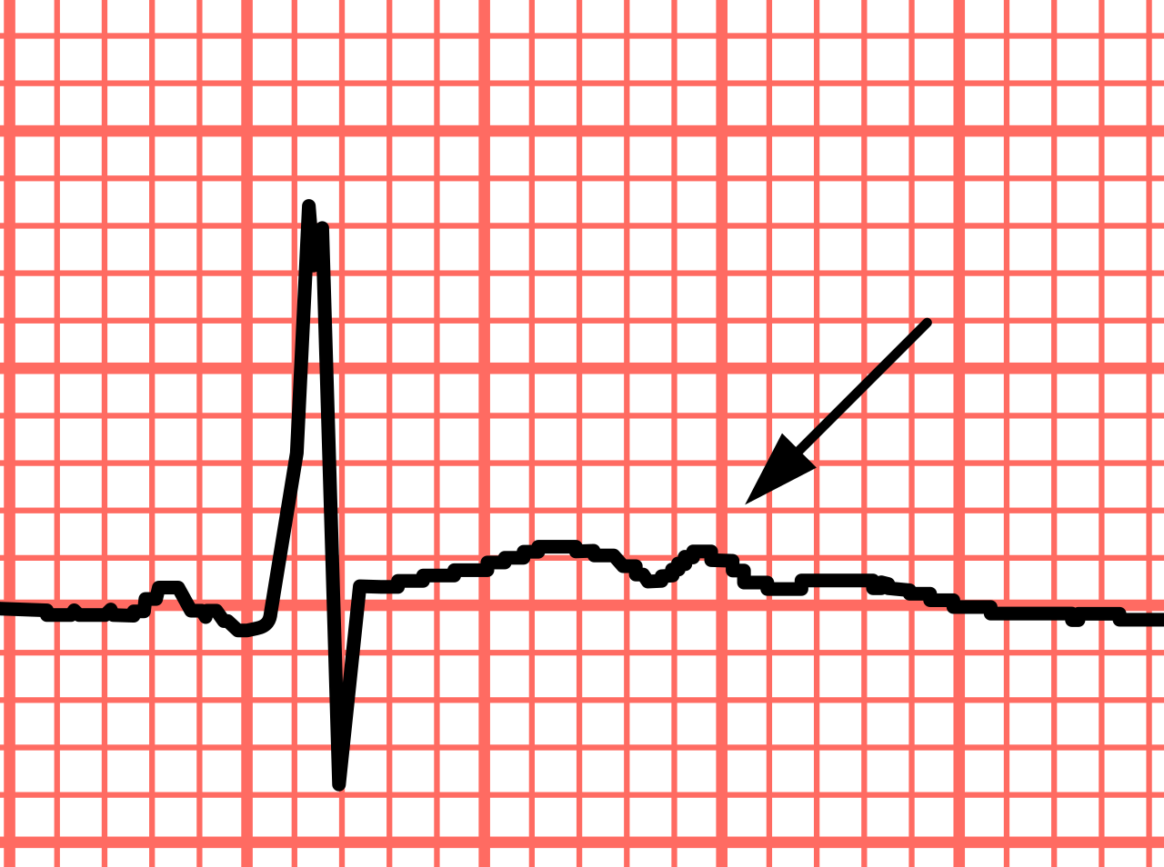 On an electrocardiogram, prominent U waves following the T wave are a classic diagnostic sign of hypokalemia.